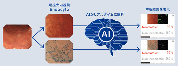 腫瘍性ポリープの可能性99％、非腫瘍性ポリープの可能性0％と判定（解析結果の右側がNBI画像）