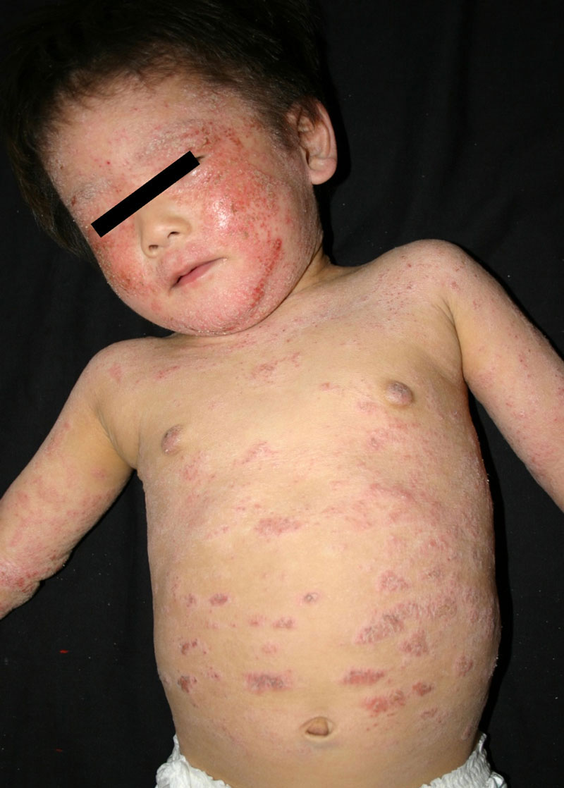 幼児の患者が多いアトピー性皮膚炎の症状。（佐賀大学プレスリリース資料を抜粋）