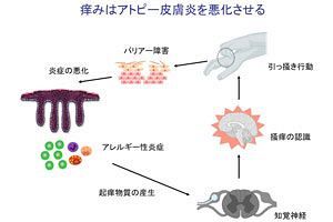 アトピー性皮膚炎患者に朗報　佐賀大、富山大のチームが痒み物質を特定